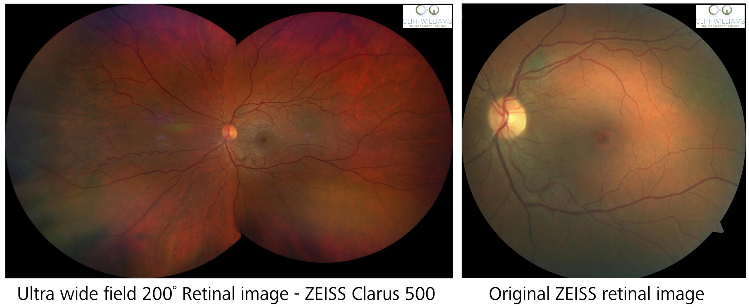 ultra wide field retinal picture using ZEISS Clarus 500 camera
